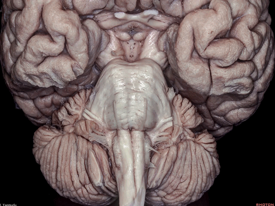 外展枕怎么使用脑干解剖及相关入路---Rhoton解剖视频学习笔记系列_https://www.jmylbn.com_新闻资讯_第4张