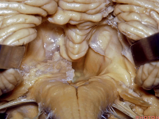 外展枕怎么使用脑干解剖及相关入路---Rhoton解剖视频学习笔记系列_https://www.jmylbn.com_新闻资讯_第239张