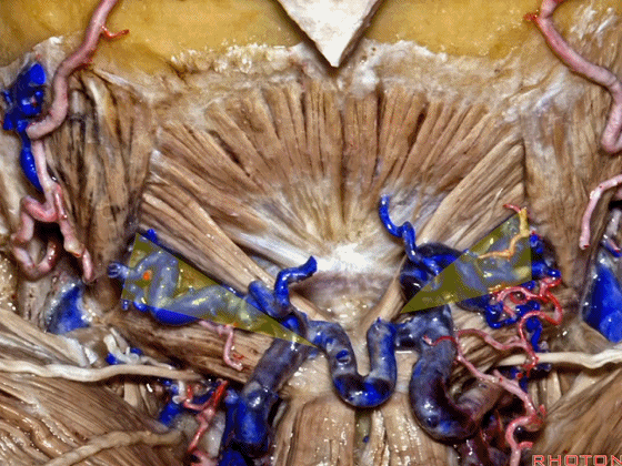 外展枕怎么使用脑干解剖及相关入路---Rhoton解剖视频学习笔记系列_https://www.jmylbn.com_新闻资讯_第318张