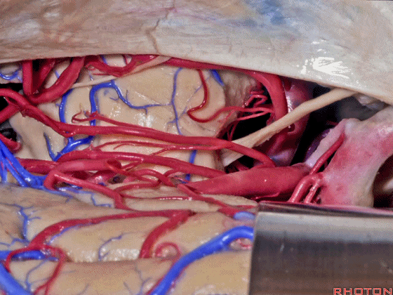 外展枕怎么使用脑干解剖及相关入路---Rhoton解剖视频学习笔记系列_https://www.jmylbn.com_新闻资讯_第176张