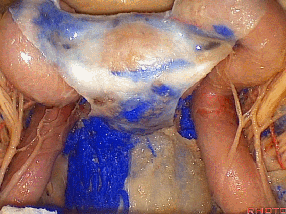 外展枕怎么使用脑干解剖及相关入路---Rhoton解剖视频学习笔记系列_https://www.jmylbn.com_新闻资讯_第343张