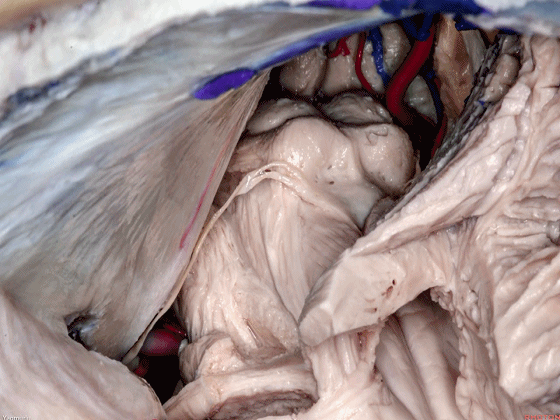 外展枕怎么使用脑干解剖及相关入路---Rhoton解剖视频学习笔记系列_https://www.jmylbn.com_新闻资讯_第61张