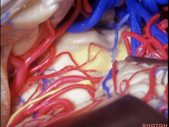 外展枕怎么使用脑干解剖及相关入路---Rhoton解剖视频学习笔记系列_https://www.jmylbn.com_新闻资讯_第220张