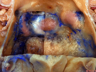 外展枕怎么使用脑干解剖及相关入路---Rhoton解剖视频学习笔记系列_https://www.jmylbn.com_新闻资讯_第342张