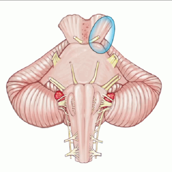 外展枕怎么使用脑干解剖及相关入路---Rhoton解剖视频学习笔记系列_https://www.jmylbn.com_新闻资讯_第145张