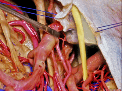 外展枕怎么使用脑干解剖及相关入路---Rhoton解剖视频学习笔记系列_https://www.jmylbn.com_新闻资讯_第204张