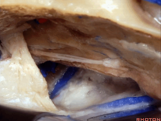 外展枕怎么使用脑干解剖及相关入路---Rhoton解剖视频学习笔记系列_https://www.jmylbn.com_新闻资讯_第192张