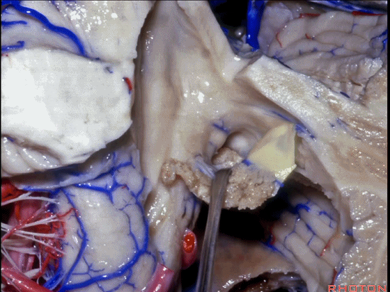 外展枕怎么使用脑干解剖及相关入路---Rhoton解剖视频学习笔记系列_https://www.jmylbn.com_新闻资讯_第253张