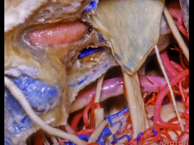 外展枕怎么使用脑干解剖及相关入路---Rhoton解剖视频学习笔记系列_https://www.jmylbn.com_新闻资讯_第303张