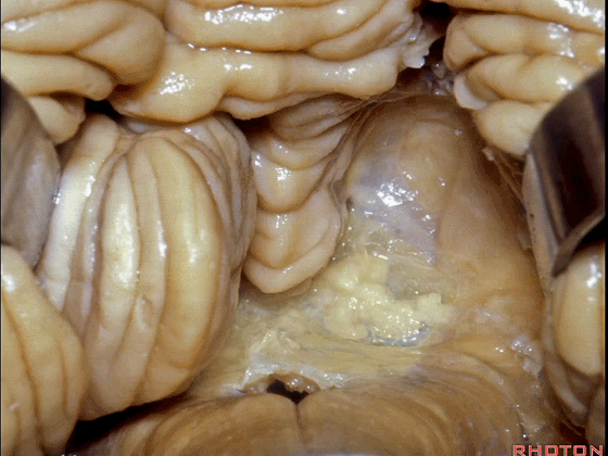 外展枕怎么使用脑干解剖及相关入路---Rhoton解剖视频学习笔记系列_https://www.jmylbn.com_新闻资讯_第235张