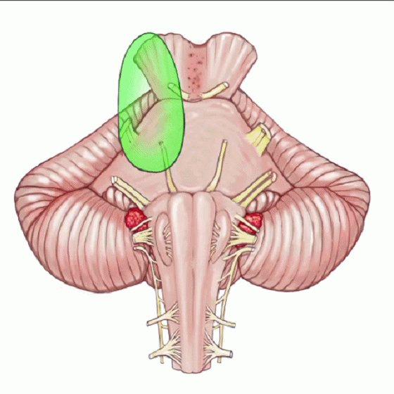 外展枕怎么使用脑干解剖及相关入路---Rhoton解剖视频学习笔记系列_https://www.jmylbn.com_新闻资讯_第180张