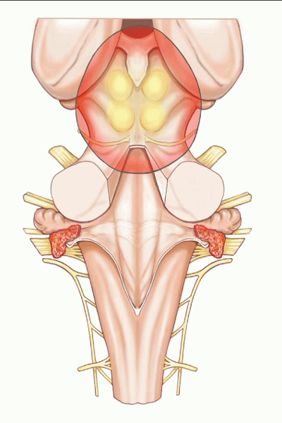外展枕怎么使用脑干解剖及相关入路---Rhoton解剖视频学习笔记系列_https://www.jmylbn.com_新闻资讯_第158张
