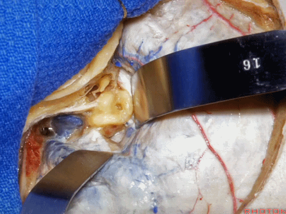 外展枕怎么使用脑干解剖及相关入路---Rhoton解剖视频学习笔记系列_https://www.jmylbn.com_新闻资讯_第294张