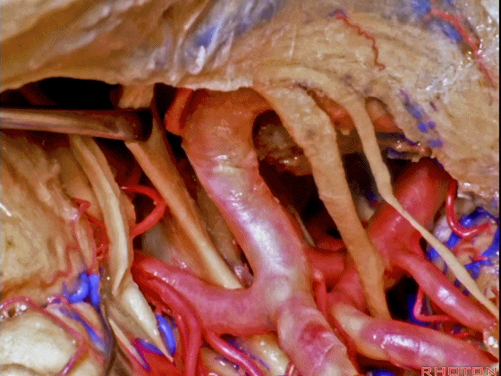 外展枕怎么使用脑干解剖及相关入路---Rhoton解剖视频学习笔记系列_https://www.jmylbn.com_新闻资讯_第207张