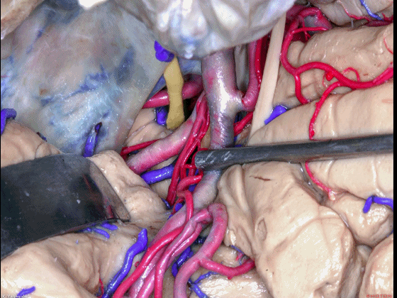 外展枕怎么使用脑干解剖及相关入路---Rhoton解剖视频学习笔记系列_https://www.jmylbn.com_新闻资讯_第45张