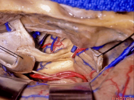 外展枕怎么使用脑干解剖及相关入路---Rhoton解剖视频学习笔记系列_https://www.jmylbn.com_新闻资讯_第193张