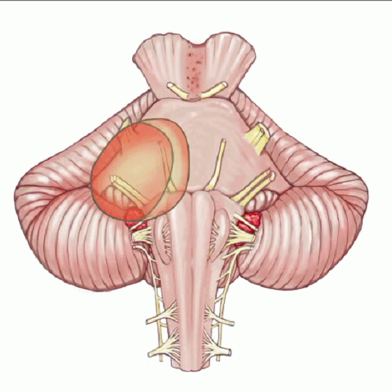 外展枕怎么使用脑干解剖及相关入路---Rhoton解剖视频学习笔记系列_https://www.jmylbn.com_新闻资讯_第277张