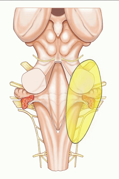 外展枕怎么使用脑干解剖及相关入路---Rhoton解剖视频学习笔记系列_https://www.jmylbn.com_新闻资讯_第157张