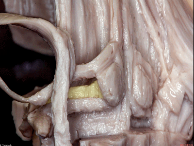 外展枕怎么使用脑干解剖及相关入路---Rhoton解剖视频学习笔记系列_https://www.jmylbn.com_新闻资讯_第113张