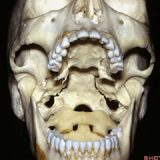 外展枕怎么使用脑干解剖及相关入路---Rhoton解剖视频学习笔记系列_https://www.jmylbn.com_新闻资讯_第306张