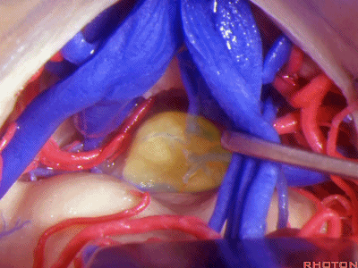 外展枕怎么使用脑干解剖及相关入路---Rhoton解剖视频学习笔记系列_https://www.jmylbn.com_新闻资讯_第215张