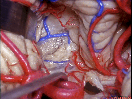外展枕怎么使用脑干解剖及相关入路---Rhoton解剖视频学习笔记系列_https://www.jmylbn.com_新闻资讯_第246张