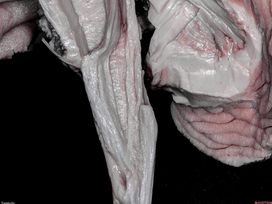 外展枕怎么使用脑干解剖及相关入路---Rhoton解剖视频学习笔记系列_https://www.jmylbn.com_新闻资讯_第137张