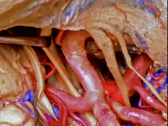 外展枕怎么使用脑干解剖及相关入路---Rhoton解剖视频学习笔记系列_https://www.jmylbn.com_新闻资讯_第208张