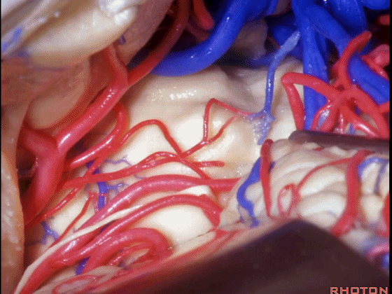 外展枕怎么使用脑干解剖及相关入路---Rhoton解剖视频学习笔记系列_https://www.jmylbn.com_新闻资讯_第221张
