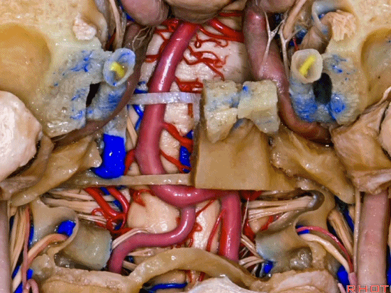 外展枕怎么使用脑干解剖及相关入路---Rhoton解剖视频学习笔记系列_https://www.jmylbn.com_新闻资讯_第355张