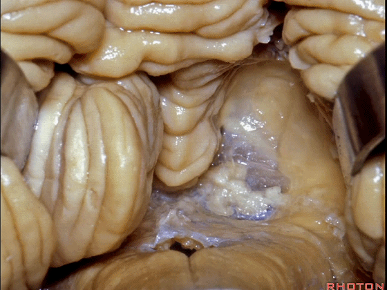 外展枕怎么使用脑干解剖及相关入路---Rhoton解剖视频学习笔记系列_https://www.jmylbn.com_新闻资讯_第236张