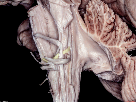 外展枕怎么使用脑干解剖及相关入路---Rhoton解剖视频学习笔记系列_https://www.jmylbn.com_新闻资讯_第100张