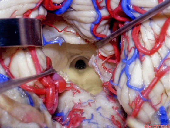 外展枕怎么使用脑干解剖及相关入路---Rhoton解剖视频学习笔记系列_https://www.jmylbn.com_新闻资讯_第247张