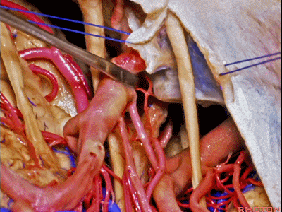 外展枕怎么使用脑干解剖及相关入路---Rhoton解剖视频学习笔记系列_https://www.jmylbn.com_新闻资讯_第205张