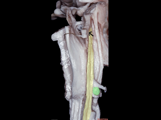 外展枕怎么使用脑干解剖及相关入路---Rhoton解剖视频学习笔记系列_https://www.jmylbn.com_新闻资讯_第19张