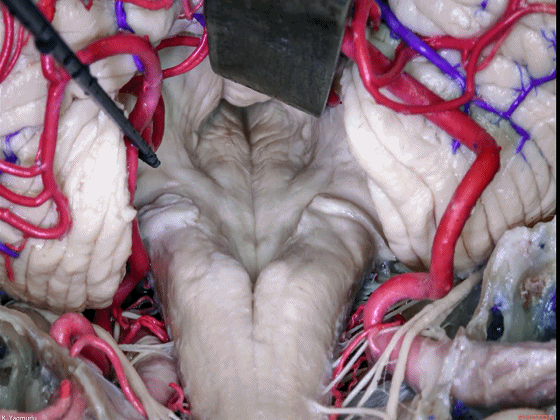 外展枕怎么使用脑干解剖及相关入路---Rhoton解剖视频学习笔记系列_https://www.jmylbn.com_新闻资讯_第107张