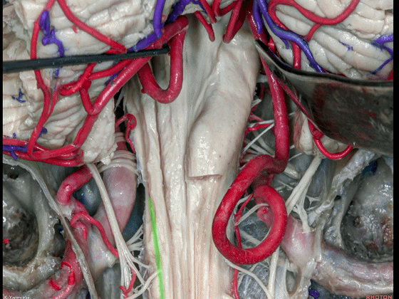 外展枕怎么使用脑干解剖及相关入路---Rhoton解剖视频学习笔记系列_https://www.jmylbn.com_新闻资讯_第143张