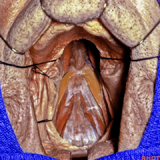 外展枕怎么使用脑干解剖及相关入路---Rhoton解剖视频学习笔记系列_https://www.jmylbn.com_新闻资讯_第311张