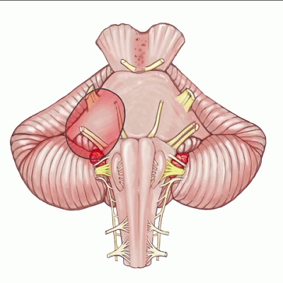 外展枕怎么使用脑干解剖及相关入路---Rhoton解剖视频学习笔记系列_https://www.jmylbn.com_新闻资讯_第276张