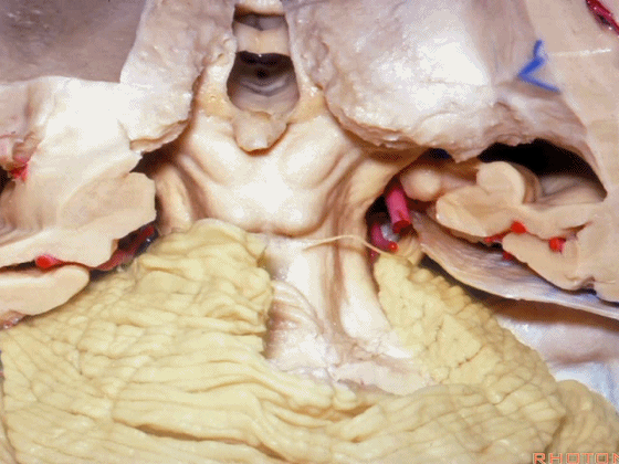 外展枕怎么使用脑干解剖及相关入路---Rhoton解剖视频学习笔记系列_https://www.jmylbn.com_新闻资讯_第212张