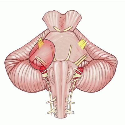 外展枕怎么使用脑干解剖及相关入路---Rhoton解剖视频学习笔记系列_https://www.jmylbn.com_新闻资讯_第151张