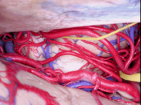 外展枕怎么使用脑干解剖及相关入路---Rhoton解剖视频学习笔记系列_https://www.jmylbn.com_新闻资讯_第60张