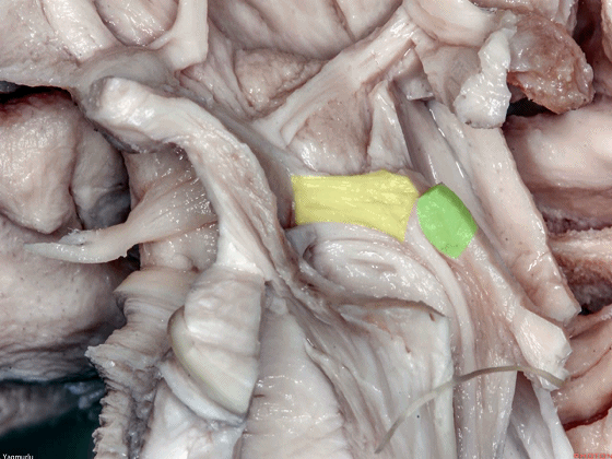 外展枕怎么使用脑干解剖及相关入路---Rhoton解剖视频学习笔记系列_https://www.jmylbn.com_新闻资讯_第55张