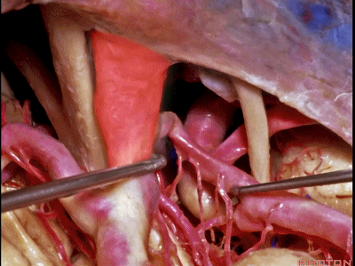 外展枕怎么使用脑干解剖及相关入路---Rhoton解剖视频学习笔记系列_https://www.jmylbn.com_新闻资讯_第201张