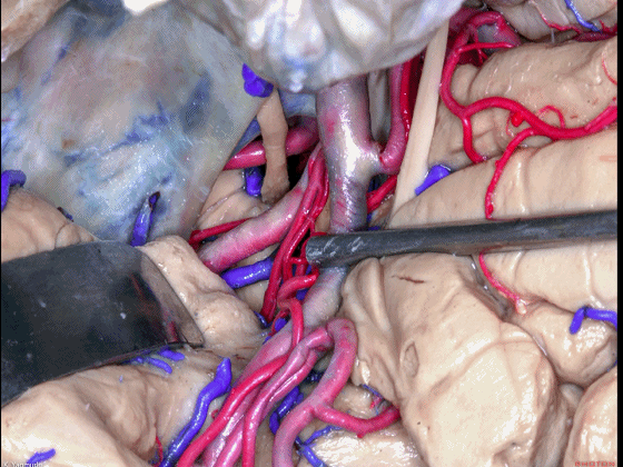 外展枕怎么使用脑干解剖及相关入路---Rhoton解剖视频学习笔记系列_https://www.jmylbn.com_新闻资讯_第44张