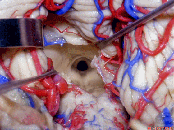 外展枕怎么使用脑干解剖及相关入路---Rhoton解剖视频学习笔记系列_https://www.jmylbn.com_新闻资讯_第248张