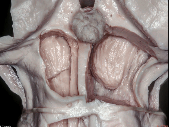 外展枕怎么使用脑干解剖及相关入路---Rhoton解剖视频学习笔记系列_https://www.jmylbn.com_新闻资讯_第82张