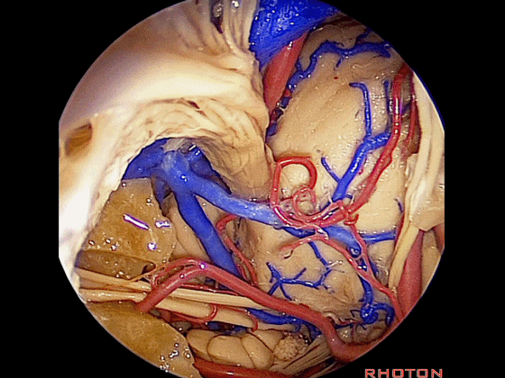 外展枕怎么使用脑干解剖及相关入路---Rhoton解剖视频学习笔记系列_https://www.jmylbn.com_新闻资讯_第362张