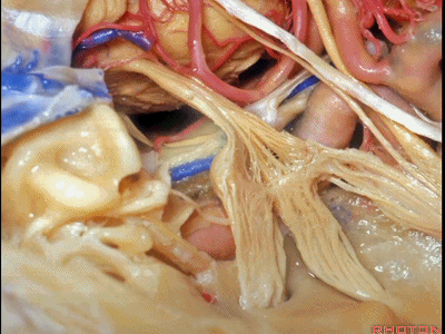 外展枕怎么使用脑干解剖及相关入路---Rhoton解剖视频学习笔记系列_https://www.jmylbn.com_新闻资讯_第185张