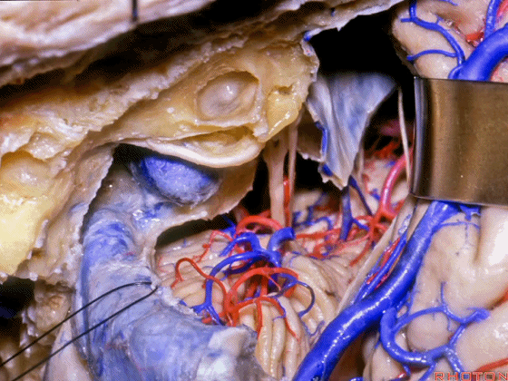 外展枕怎么使用脑干解剖及相关入路---Rhoton解剖视频学习笔记系列_https://www.jmylbn.com_新闻资讯_第299张